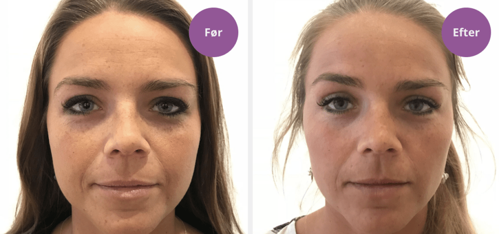 Brynløft med botox